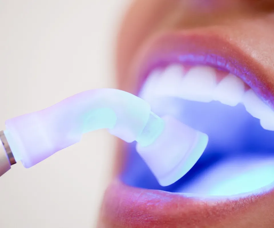 Dental Bonding or Filling
