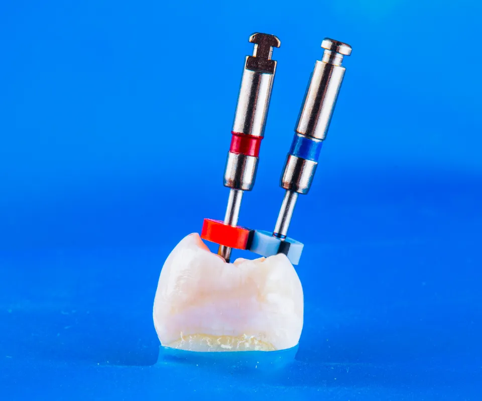 Root Canal Treatment