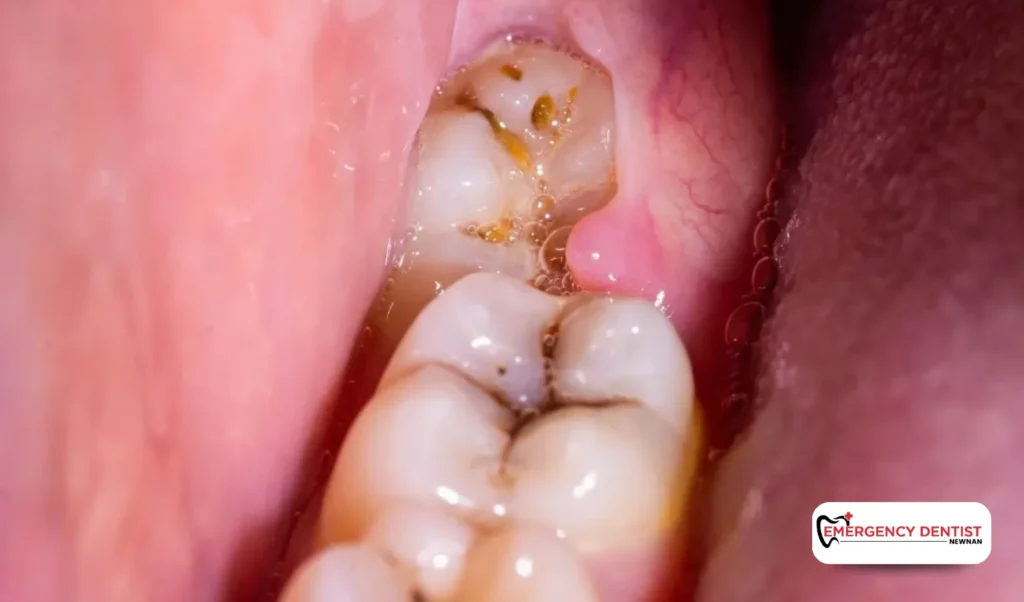 Tooth Infection Pain and Abscess Tooth Pain