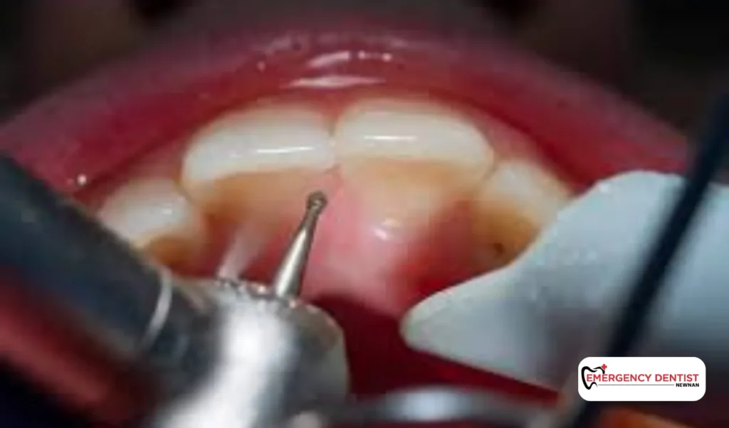 Tooth Pain After Filling What’s Normal