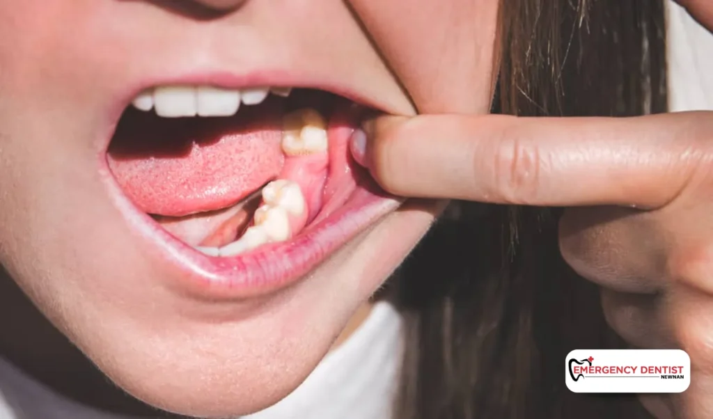 Tooth Pain After Tooth Pulled Is It Part of the Healing or a Dry Socket