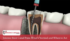Intense Root Canal Pain What’s Normal and When to Act