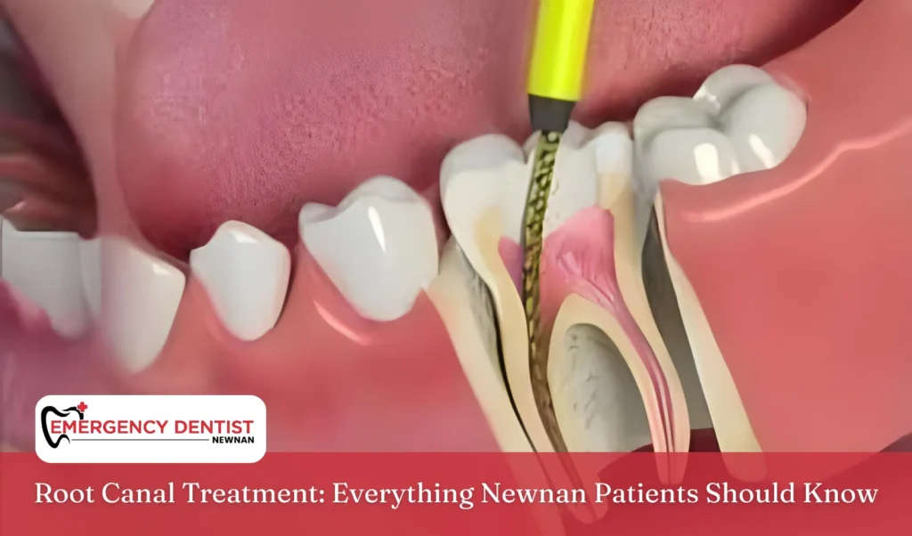 Root Canal Treatment Everything Newnan Patients Should Know