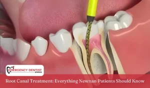 Root Canal Treatment Everything Newnan Patients Should Know
