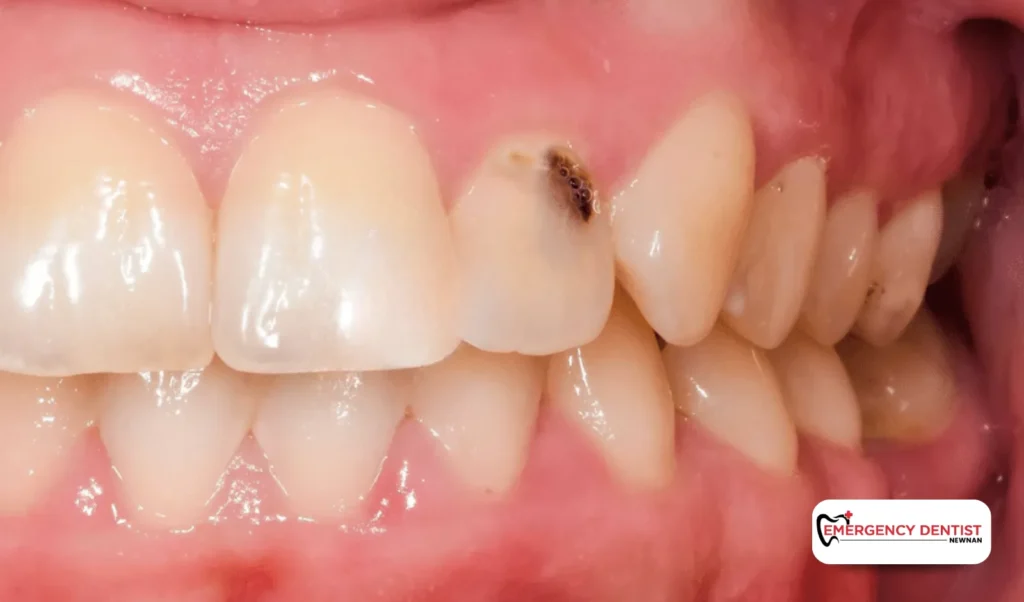 What Causes Root Canal Treatment to Be Necessary