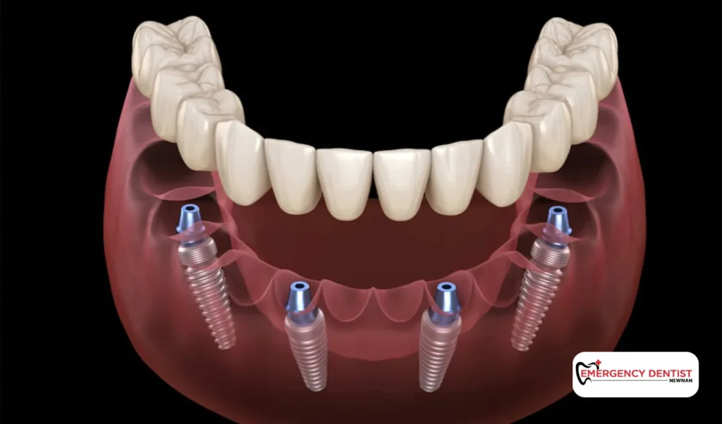 Considering Dental Implants After Tooth Removal