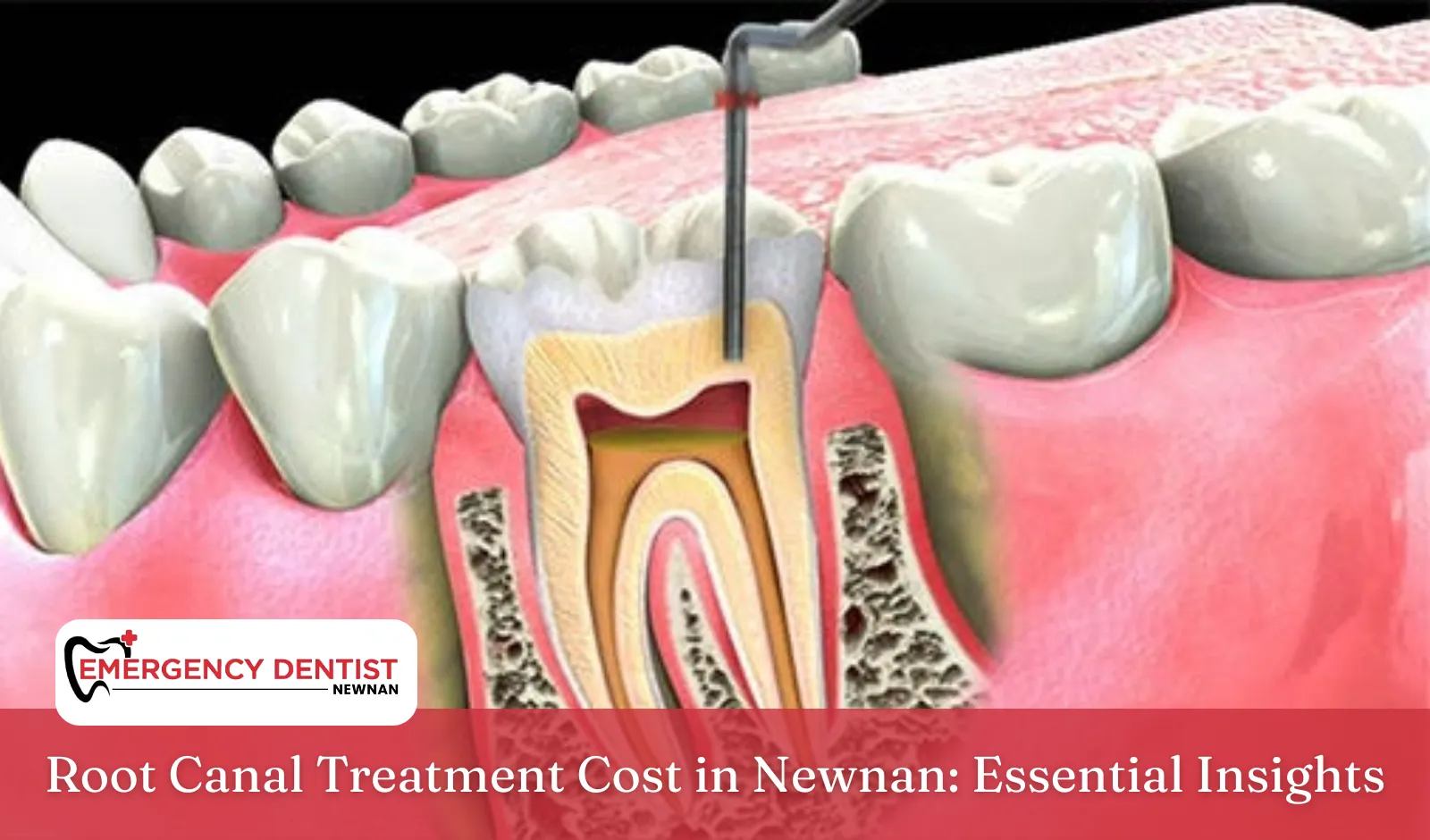 Root Canal Treatment Cost in Newnan Essential Insights