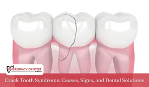 Crack Tooth Syndrome Causes, Signs, and Dental Solutions