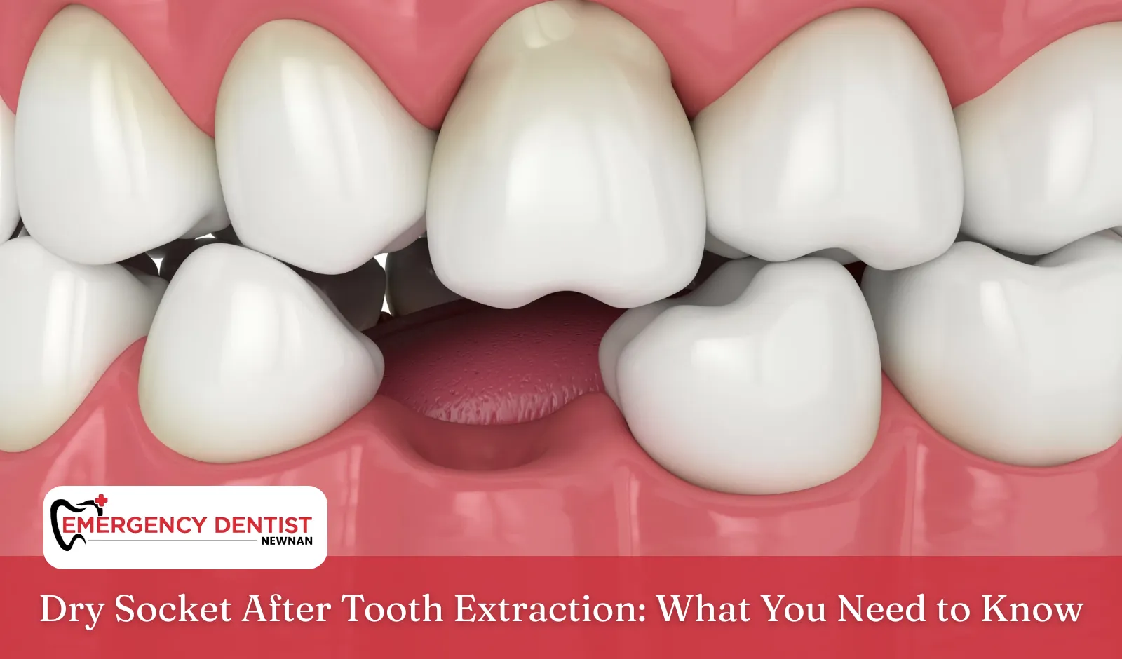 Dry Socket After Tooth Extraction: What You Need to Know
