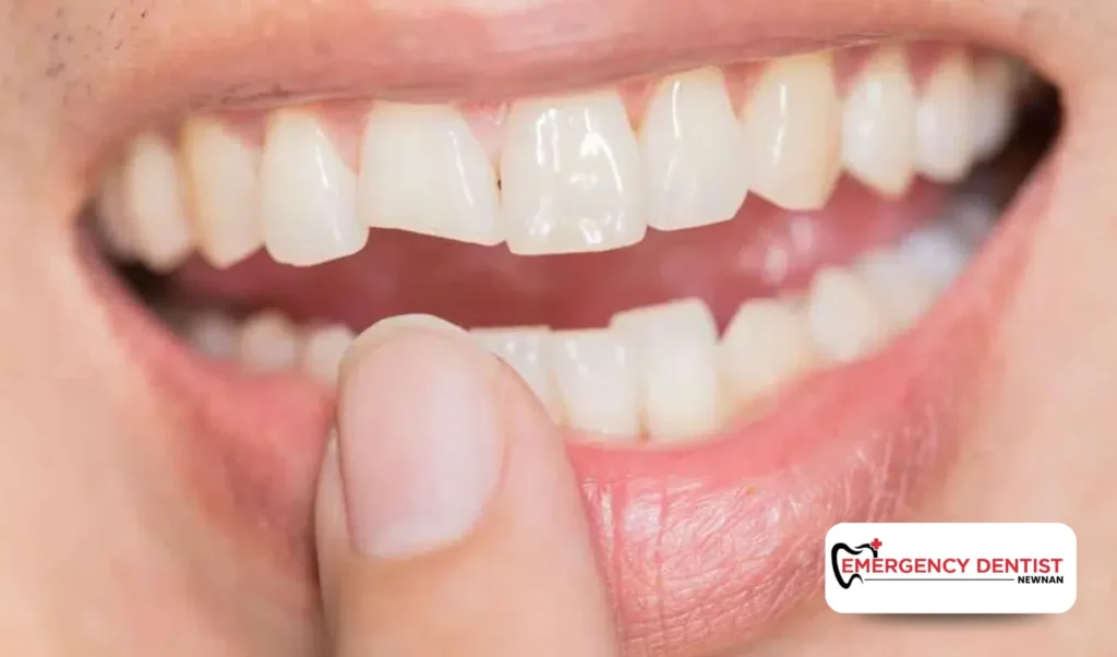 Common Sports-Related Dental Injuries