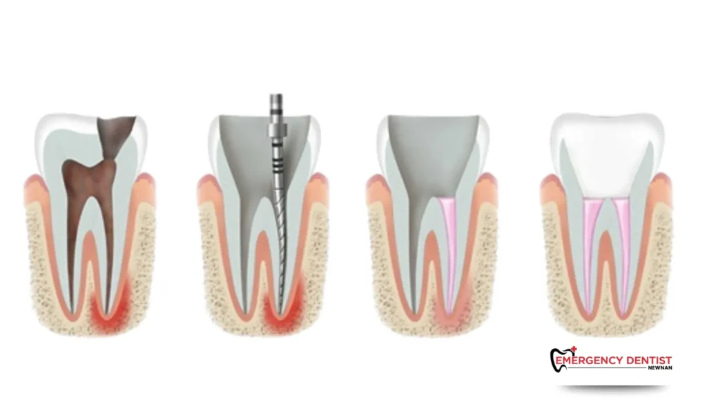 Treatment Options for a Cracked Tooth