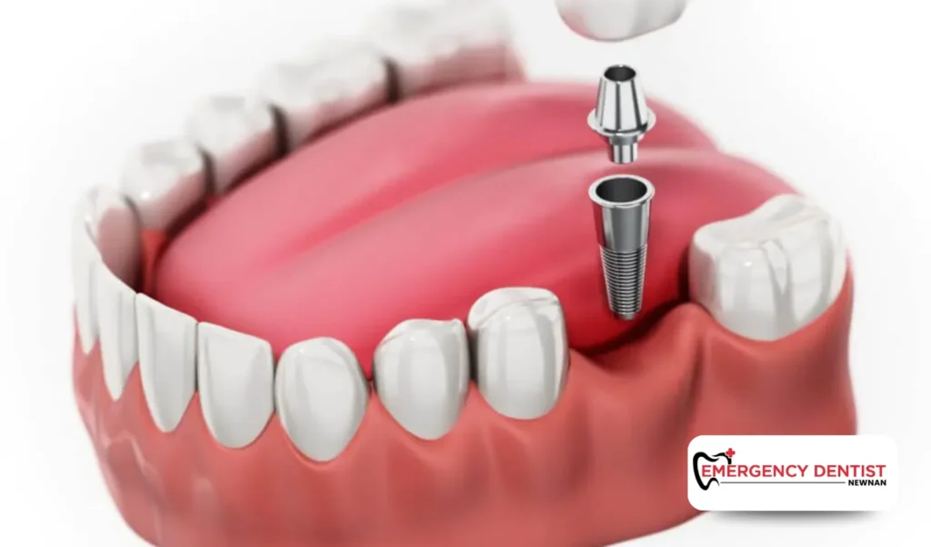What Are Dental Implants and Why Do People Get Them