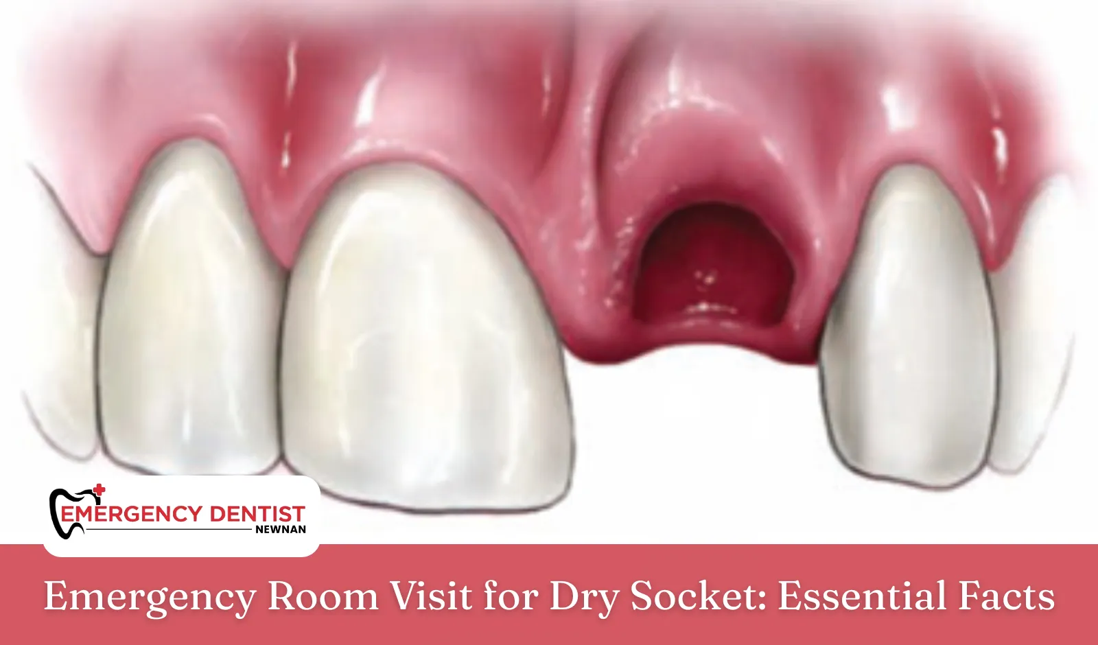 Emergency Room Visit for Dry Socket: Essential Facts