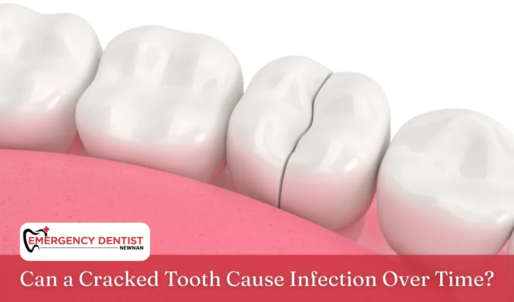 Can a Cracked Tooth Cause Infection Over Time