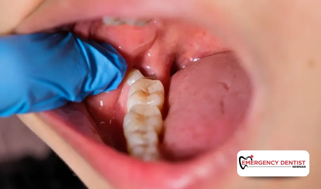 How Dentists Treat Wisdom Tooth Infections