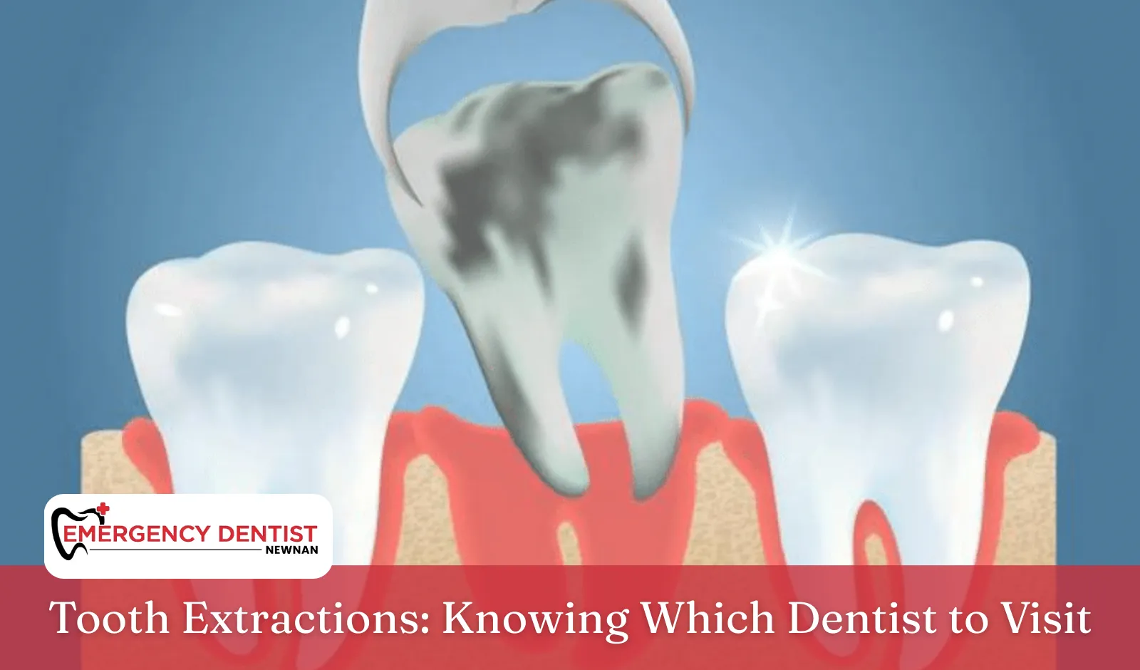 Tooth Extractions: Knowing Which Dentist to Visit