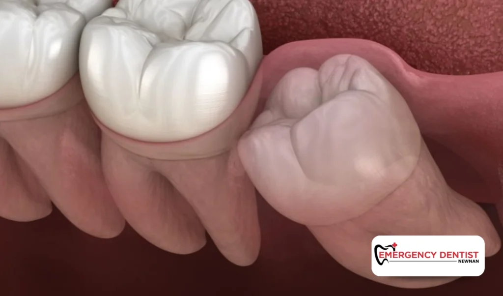 Why Wisdom Teeth Often Cause Discomfort