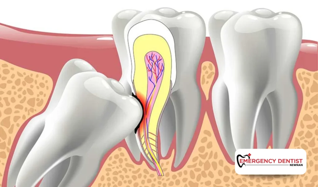 When Wisdom Teeth Removal May Be Recommended