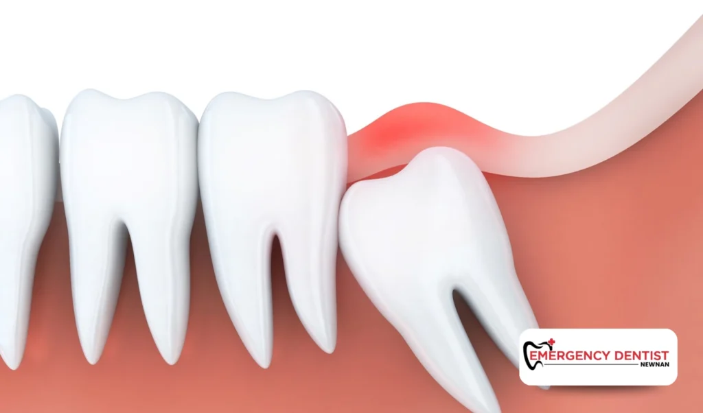 Why Wisdom Teeth Removal May Be Recommended