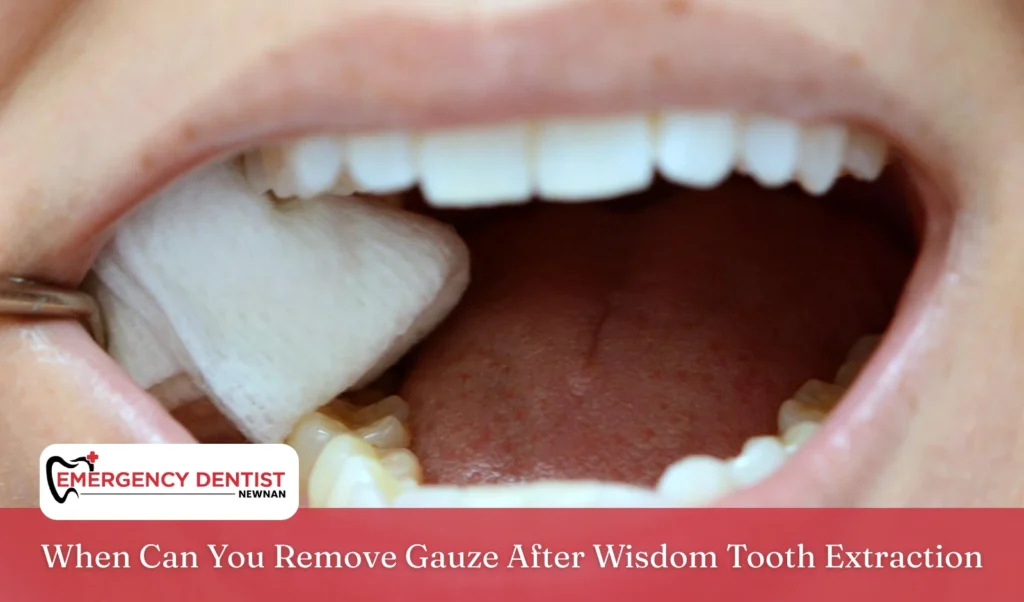 When Can You Remove Gauze After Wisdom Tooth Extraction