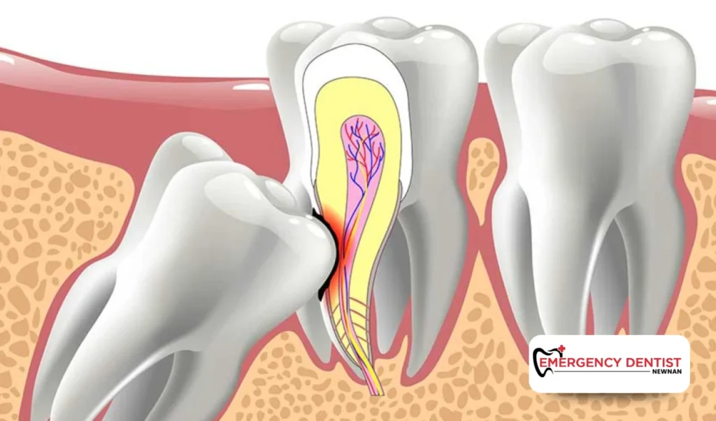 Why Wisdom Teeth Often Need to Be Removed