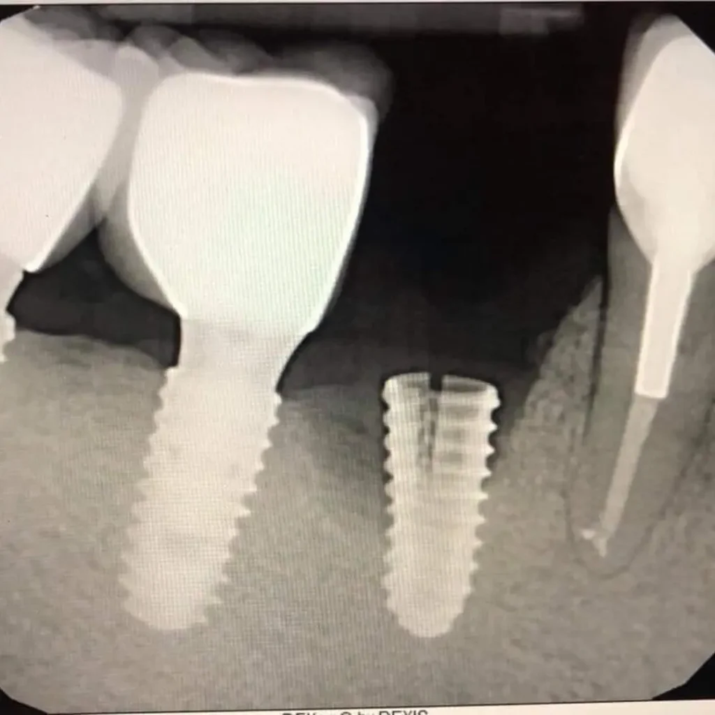 Cracked-or-fractured-implants-Newnan-GA