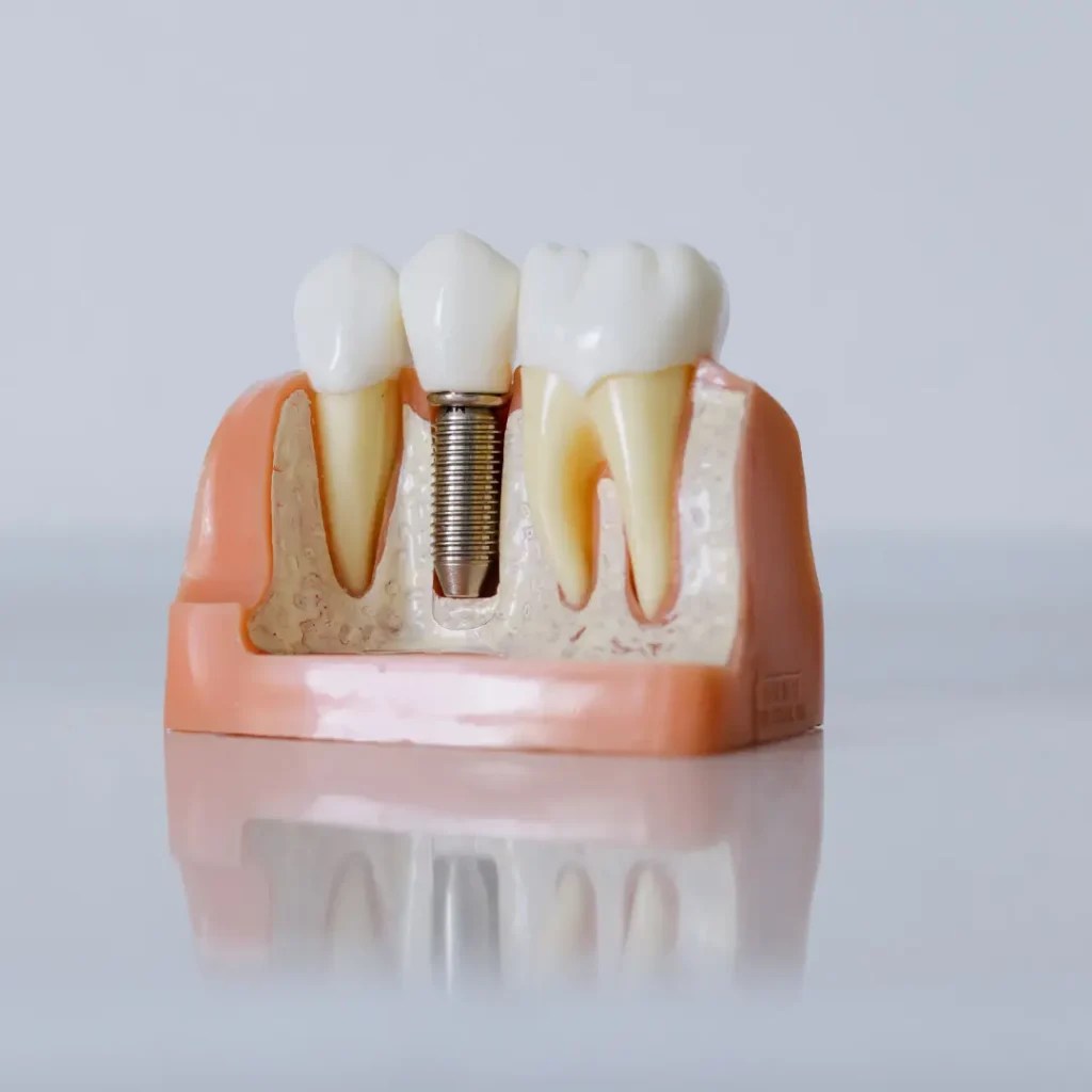 Emergency-Dental-Implant-Newnan-GA