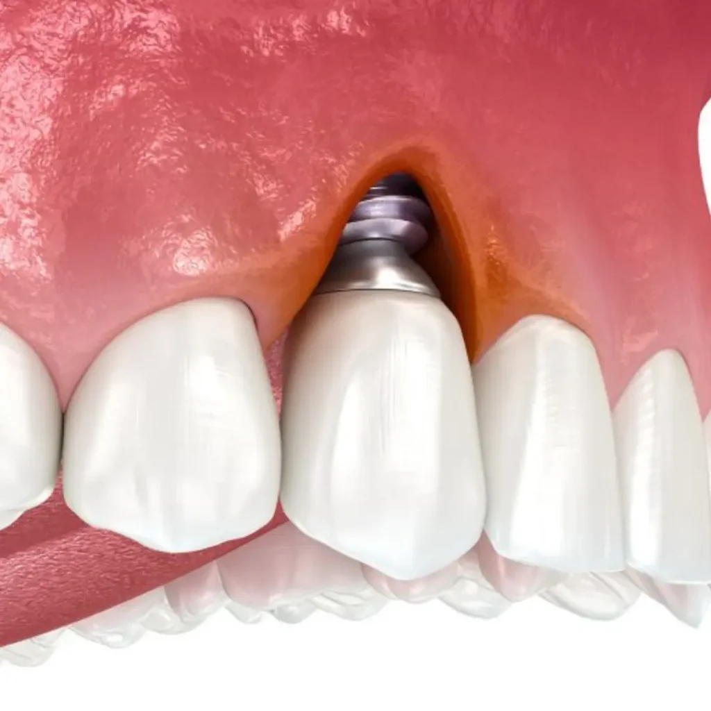 Infection-or-pain-around-an-implant-Newnan-GA