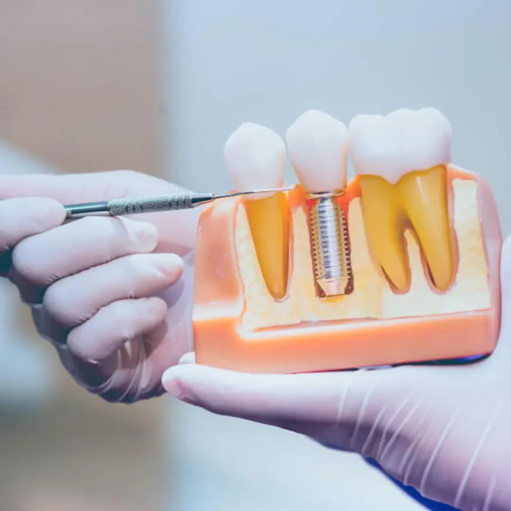 Loose-or-shifting-dental-implants-Newnan-GA