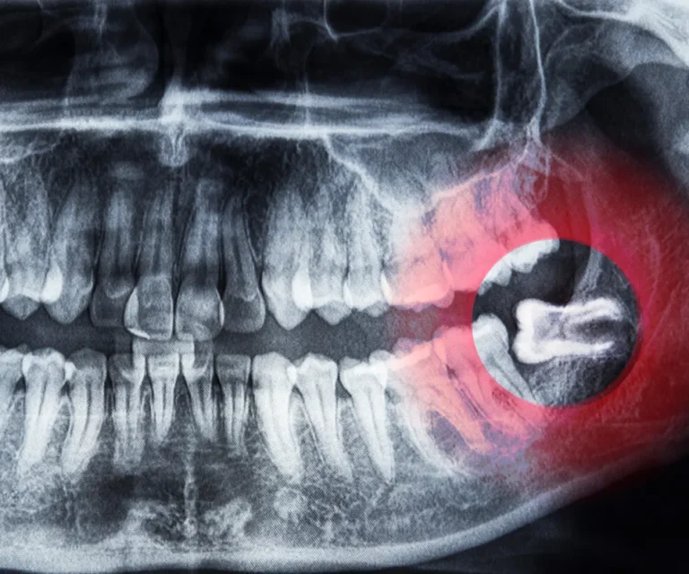 Wisdom-Tooth-Infection-Emergencies-Newnan-GA