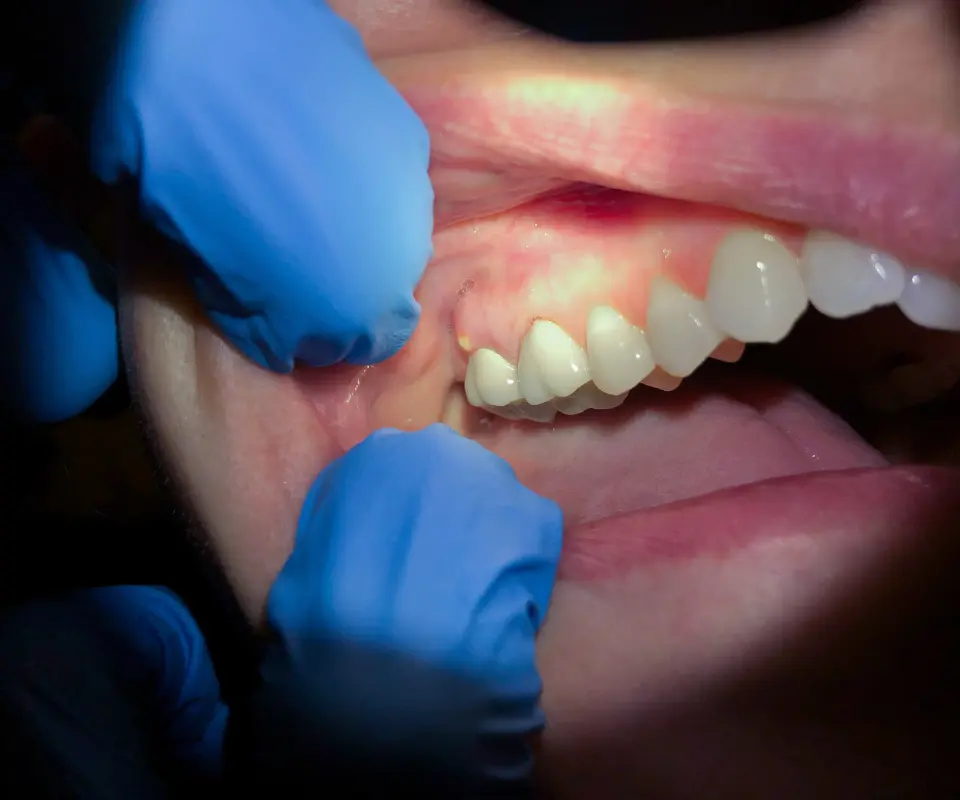 Abscesses-or-Infections-Newnan-GA