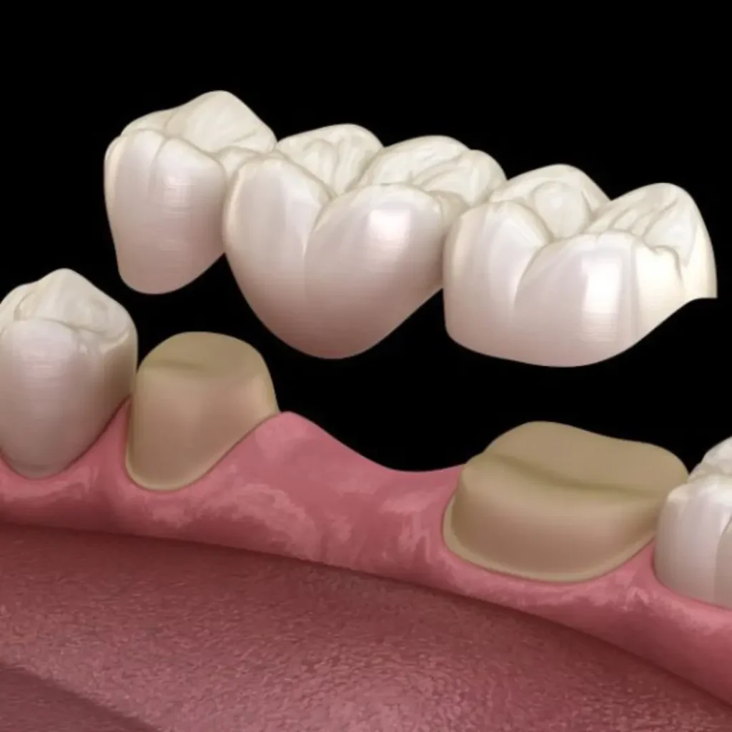 Accidental-damage-from-injury-or-biting-down-Newnan-GA