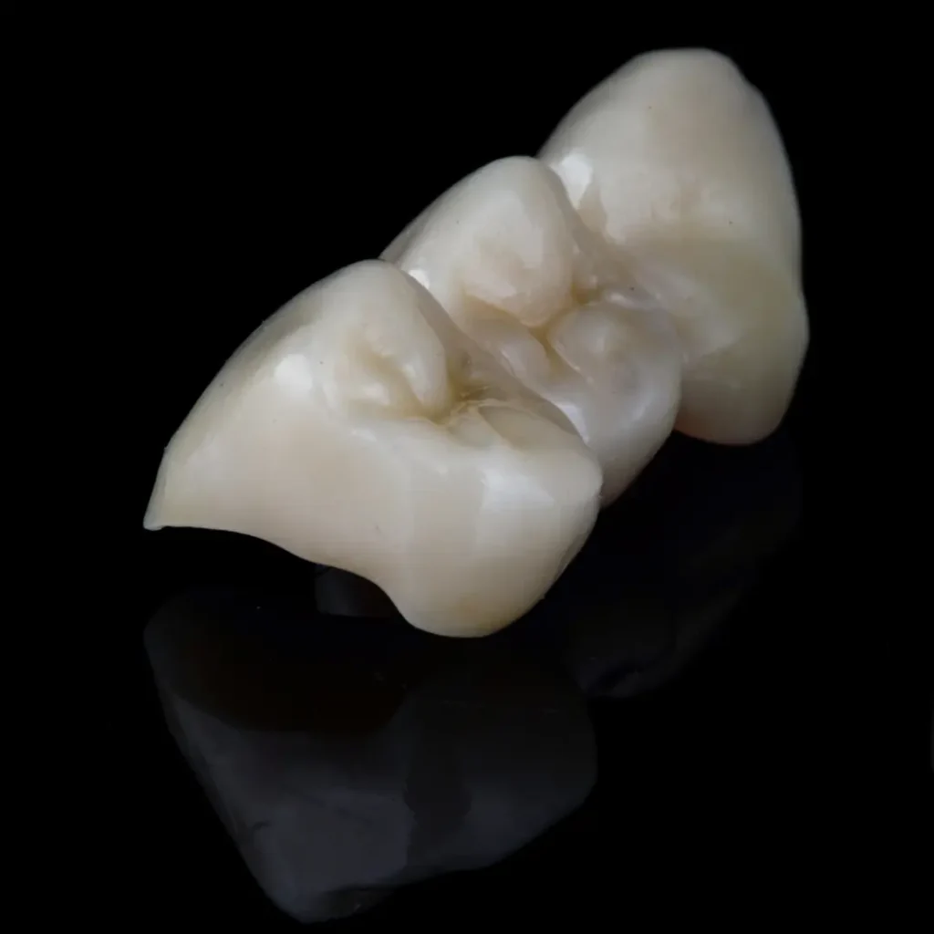 Broken-or-cracked-dental-bridge-Newnan-GA