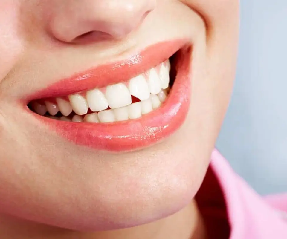 Chipped-Teeth-Newnan-GA