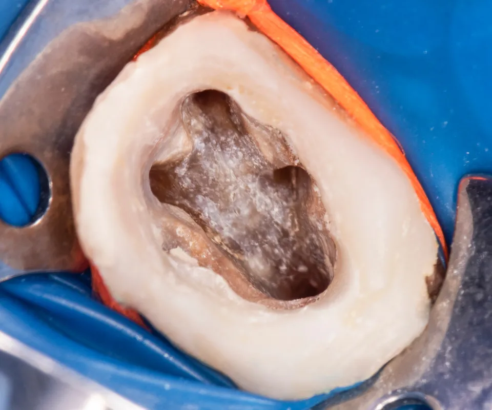 Cleaning-the-Root-Canal-Newnan-GA