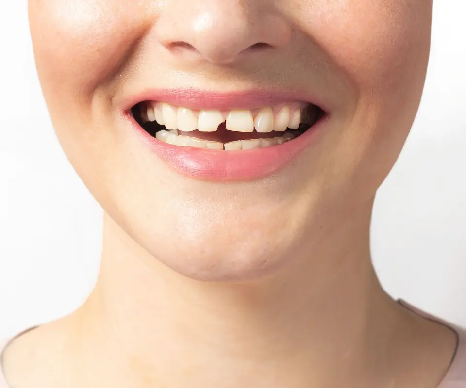 Cracked-or-Broken-Teeth-Newnan-GA