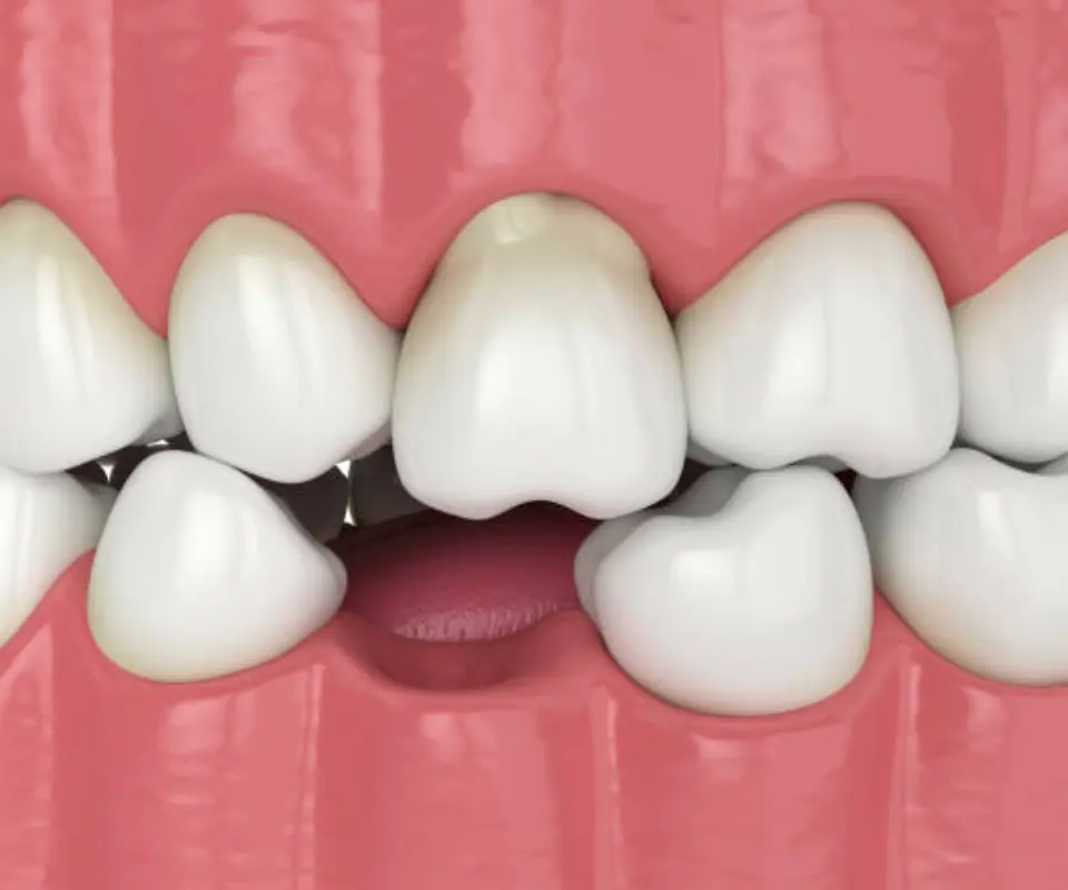 Dislocated-Teeth-Newnan-GA