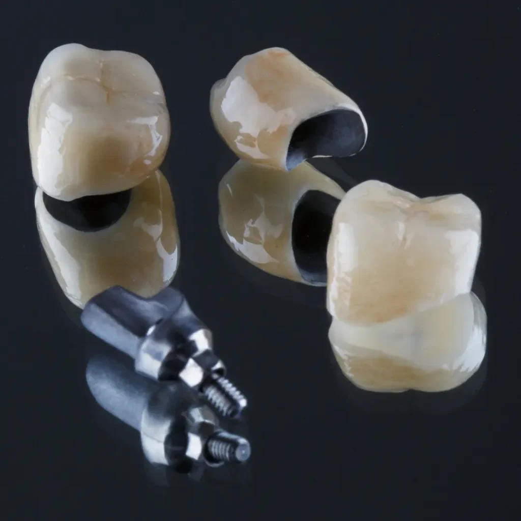 Loose-dental-bridge-or-crown-Newnan-GA