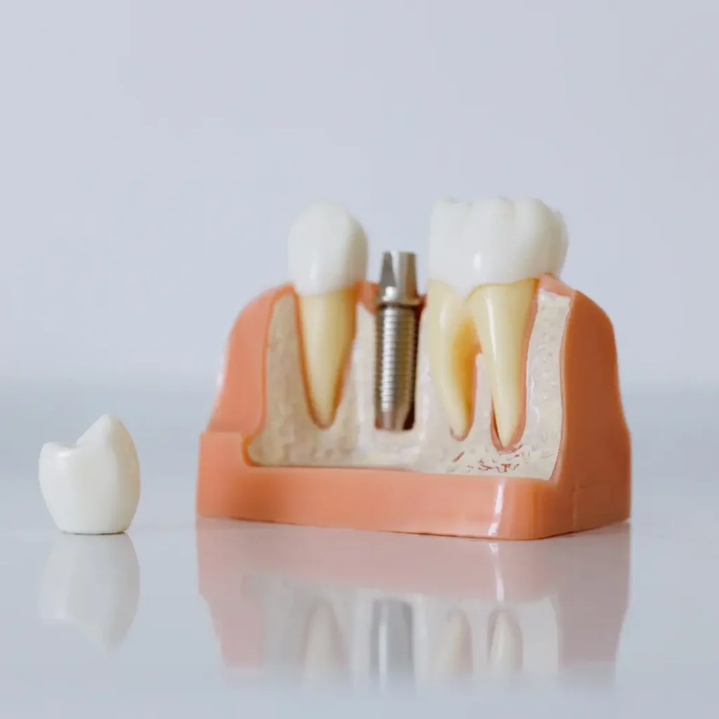The-implant-crown-fell-off-or-broke-Newnan-GA