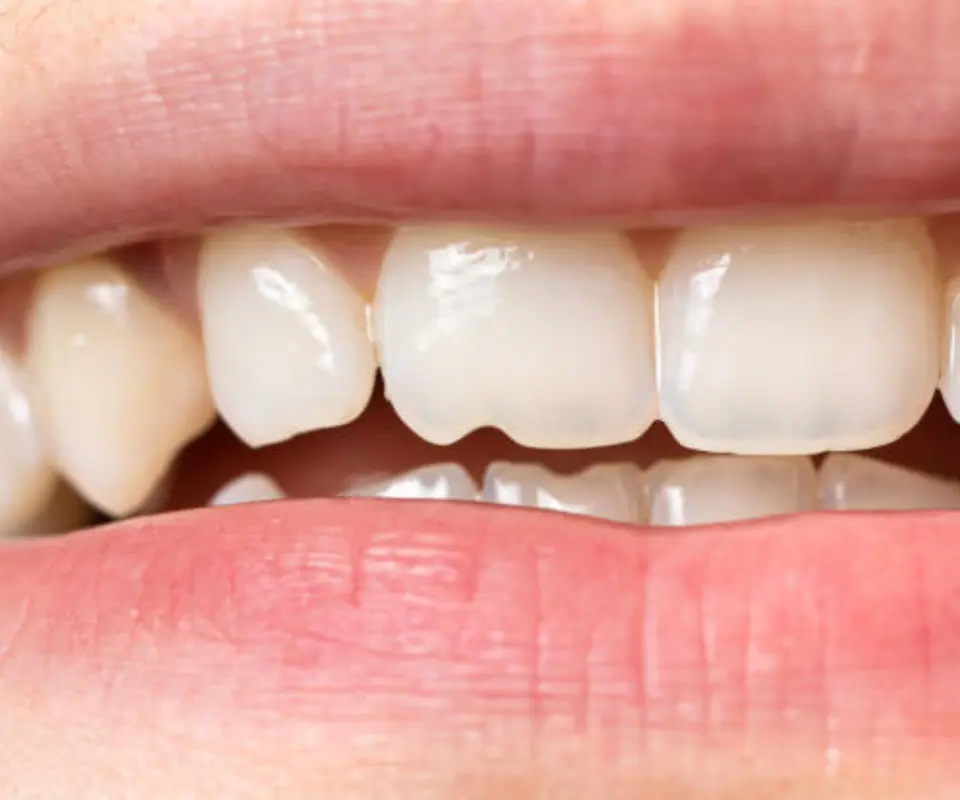 Tooth-Fractures-Newnan-GA