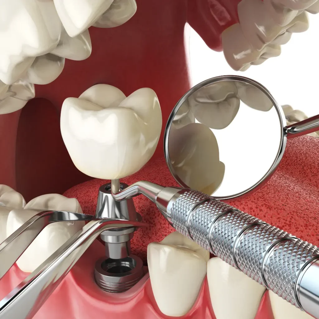 Trauma-related-tooth-loss-needs-immediate-implants-Newnan-GA