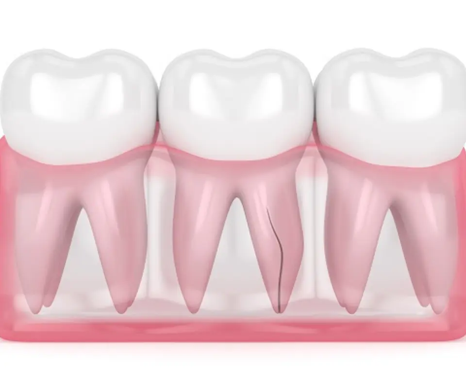 Vertical-Root-Fracture-Newnan-GA