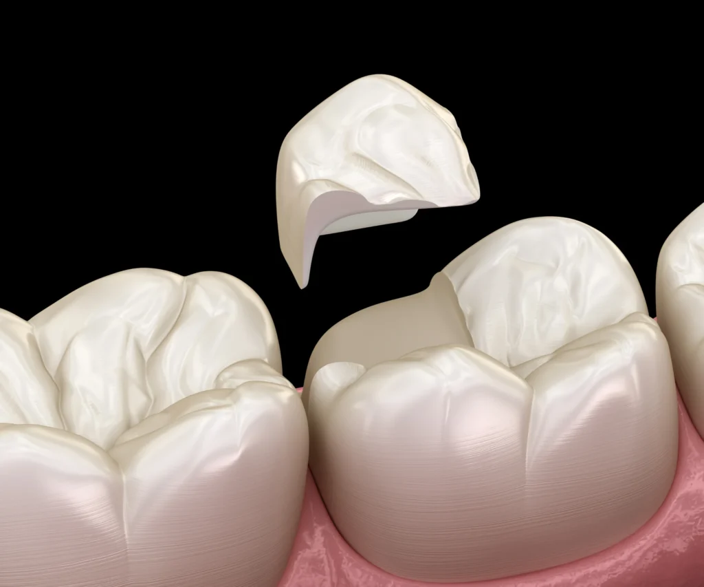 What-Causes-a-Cracked-Tooth-Newnan-GA