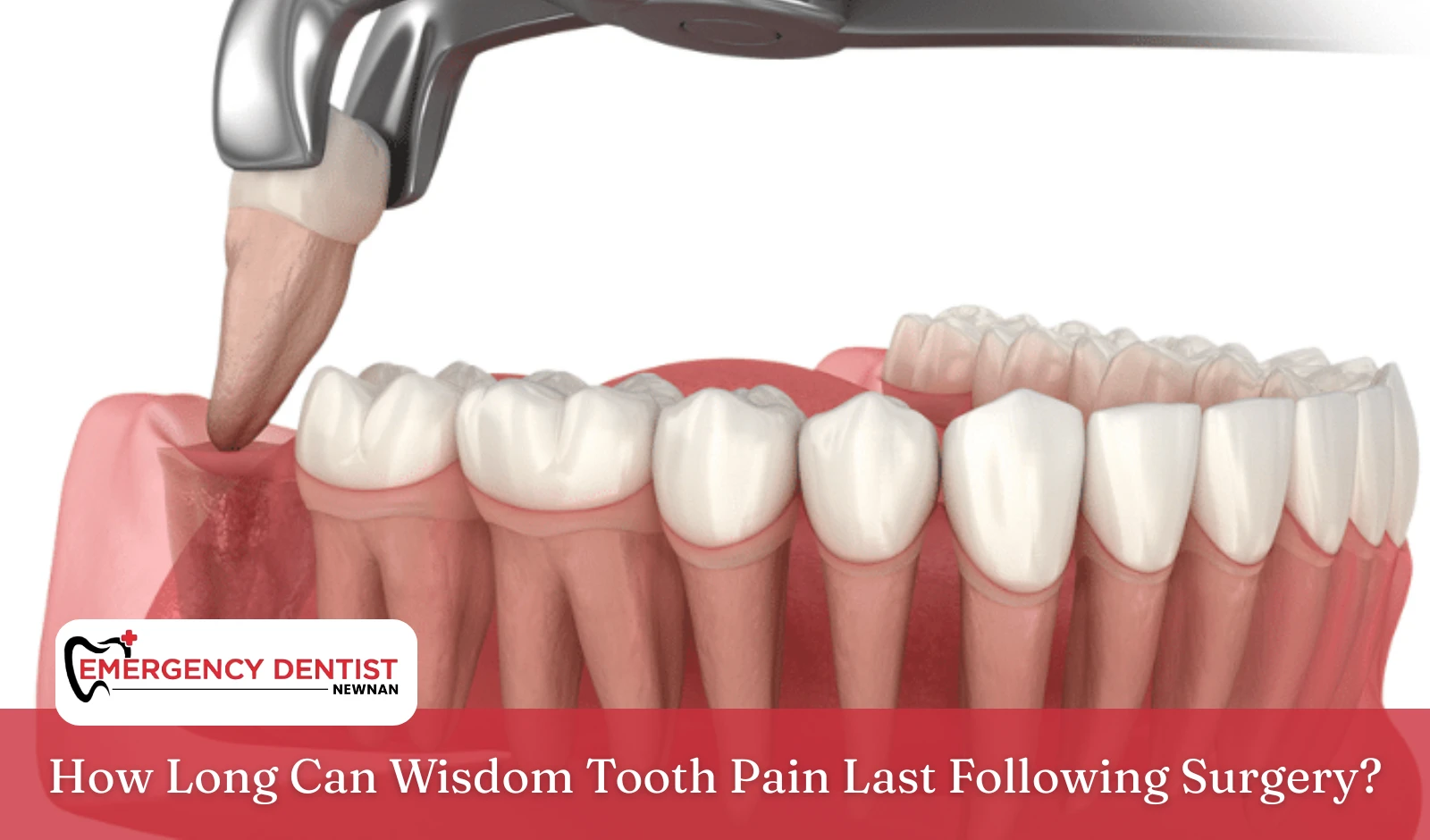 how-long-wisdom-tooth-pain-lasts-after-surgery